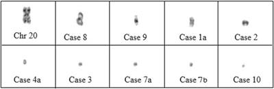 Small supernumerary marker chromosomes in prenatal diagnosis—molecular characterization and clinical outcomes